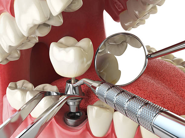 Best Emergency Root Canal Treatment in Villisca, IA